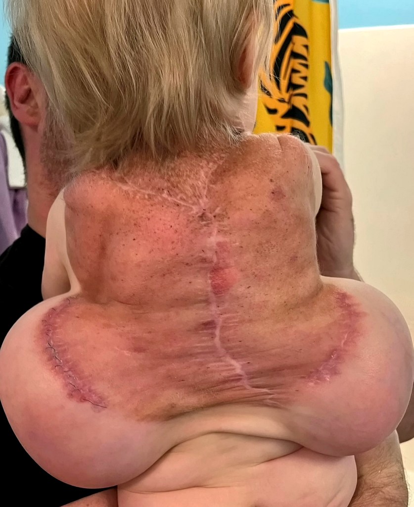 Baby with large dark mass on back.