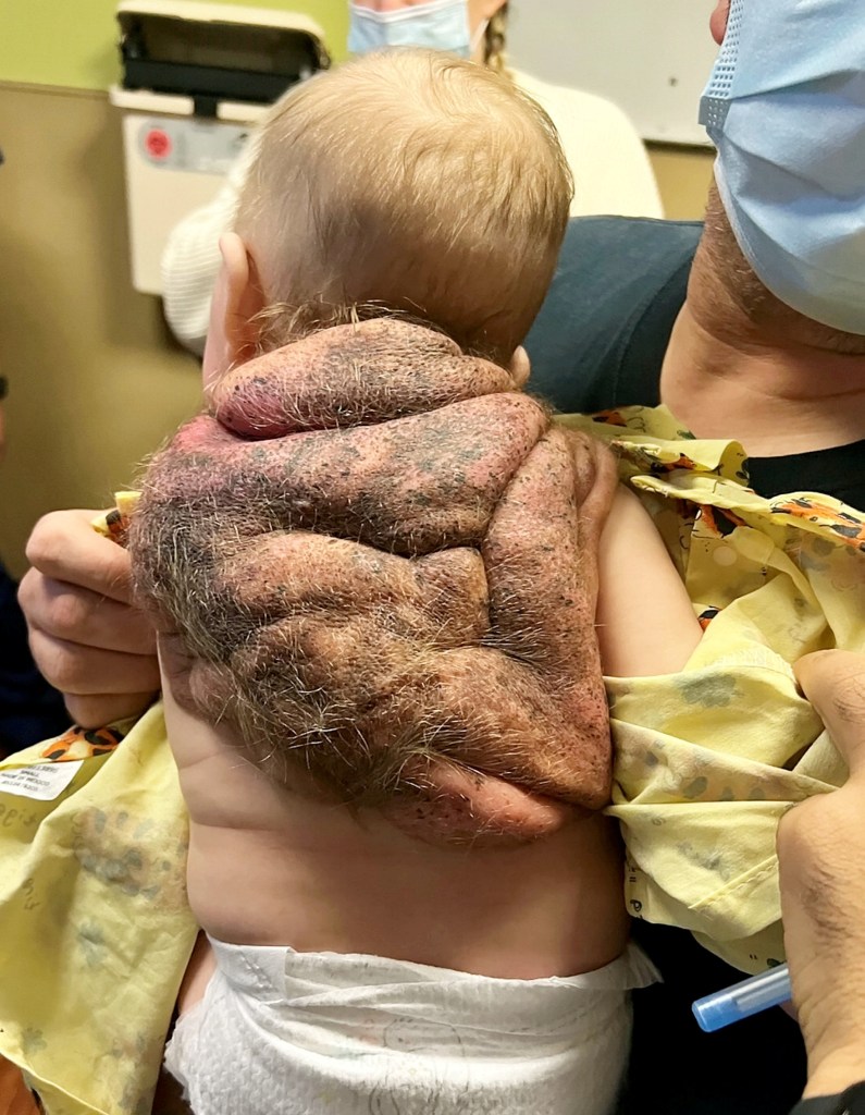 Baby with large dark growth on his back.