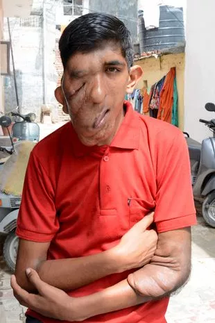 Bhupinder Singh has been left with a SAGGING face thanks to a rare condition